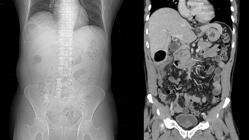 Abdominal CT Scan