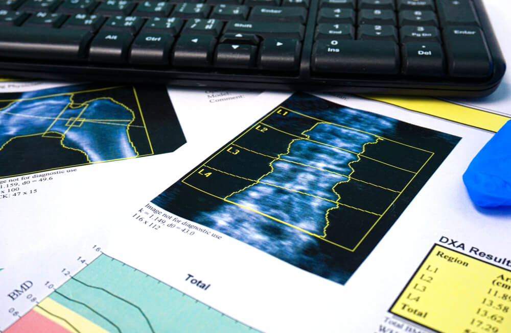Close up Bone Densitometry Result on the table in room doctor. Healthcare and technology concept.