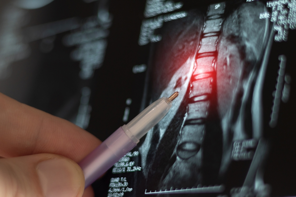 Doctor learn MRI or CT image for diagnostic spine trauma