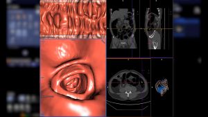 1-What-Is-CT-Colonography-(Virtual-Colonoscopy)-A-Complete-Guide